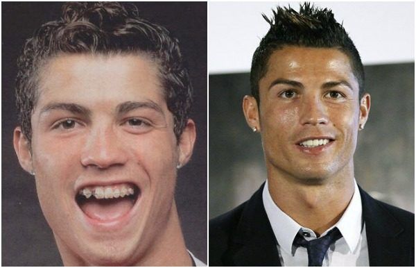 cristiano-facette-dentaire.png