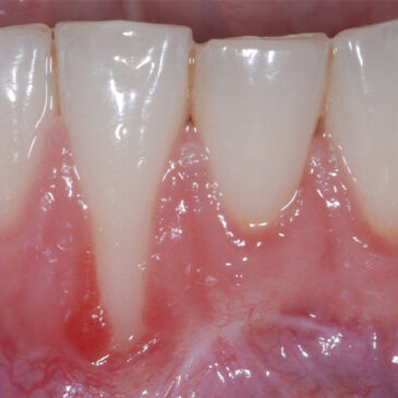 Les 5 stades de la récession gingivale à surveiller pour une santé Bucco-dentaire optimale