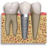 L’implant monophase : une solution innovante en implantologie dentaire